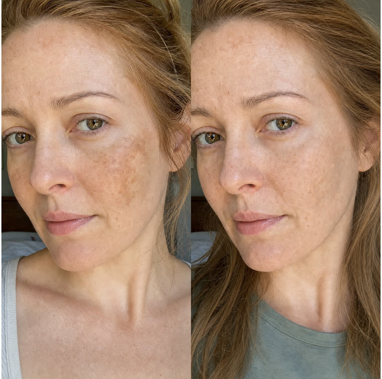 Before and after: Cheeks