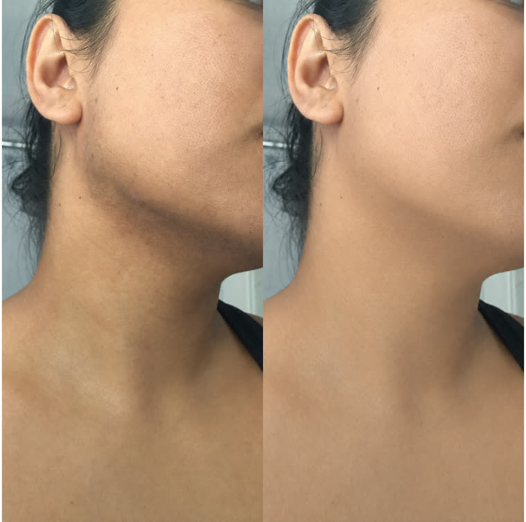 Before and after: Jawline