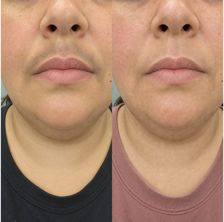 Before and after: Upper lip