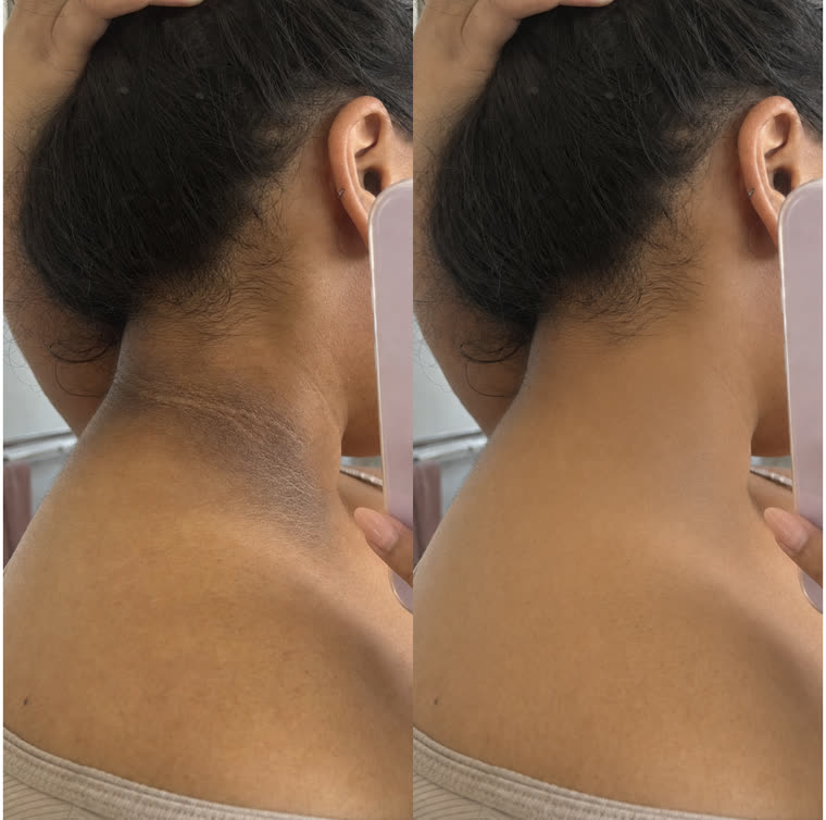 Before and after: Neck