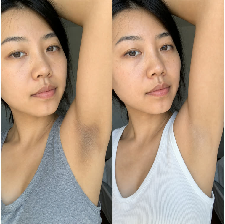 Before and after: Underarms